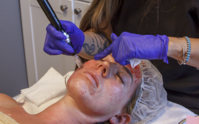 RejuviTox Microneedling: Achieve Radiant, Youthful Skin